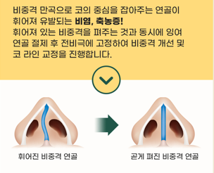 바노바기 기능코 수술 실비 적용으로 코 질환 개선과 예쁜 콧대까지! 관련 이미지 2