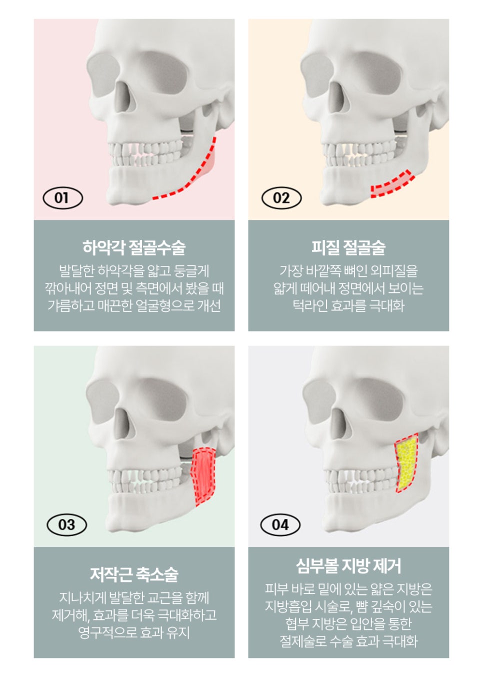 사각턱 수술, 나에게 맞는 라인으로 어느 각도에서도 매력적인 턱 라인 관련 이미지 3