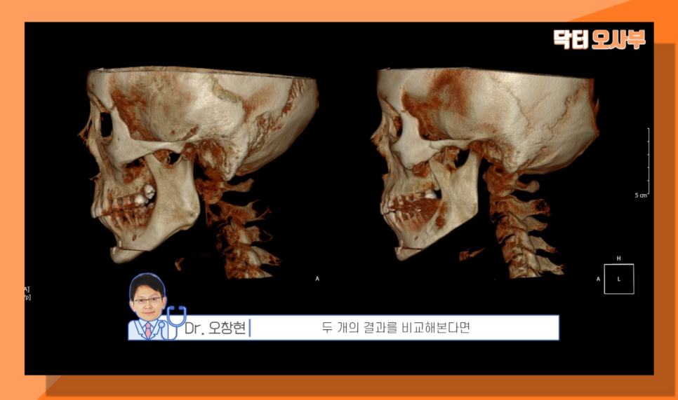 사각턱수술 부작용? 이차각? 닥터오사부랑 제대로 알아보자! 관련 이미지 7