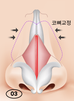 휘어진 콧대와 코 속을 한 번에 바로잡는 휜코 성형 관련 이미지 7