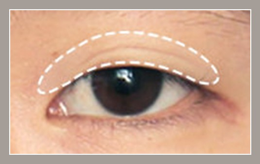 눈 재수술의 다양한 원인과 재수술 방법 관련 이미지 2