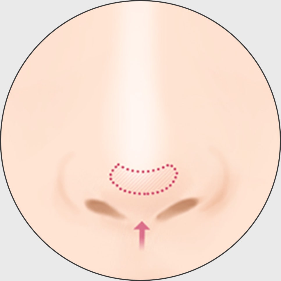 코 재수술, 적합한 시기에 원인에 따른 올바른 방법으로 개선해야 합니다! 관련 이미지 11
