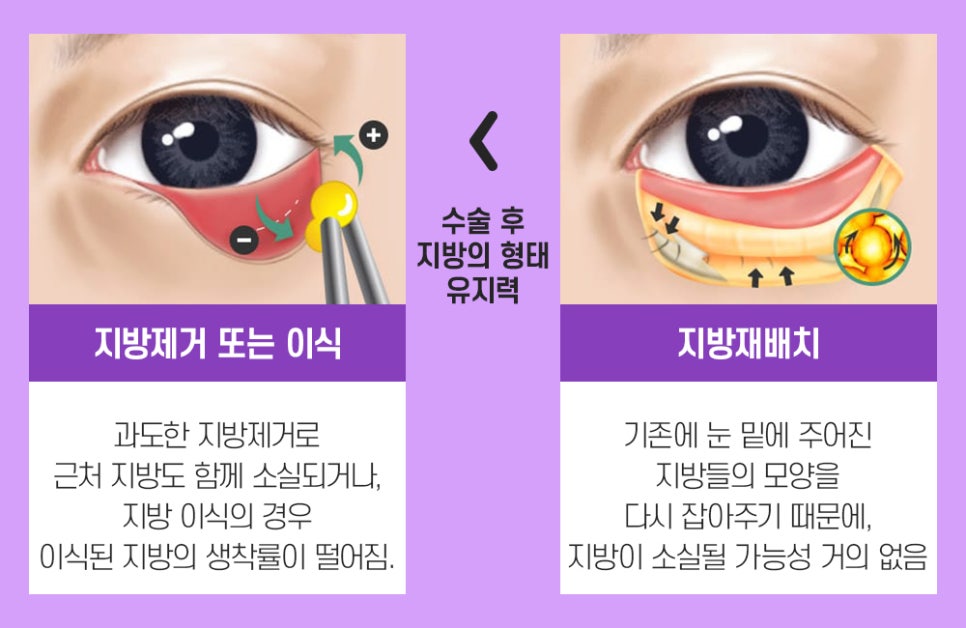 어두운 눈가를 개선하는 눈 밑 지방재배치의 장점과 수술법 관련 이미지 3