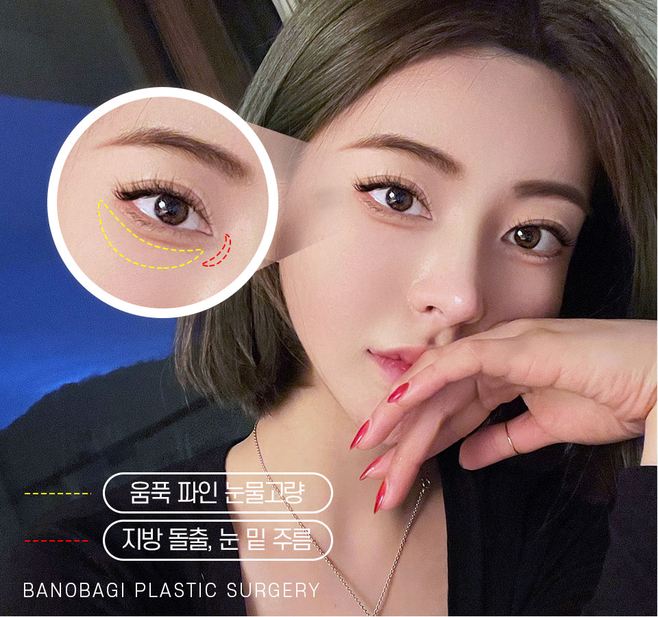 눈밑 지방재배치, 볼록하고 어두운 눈가를 환하게 개선 관련 이미지 2