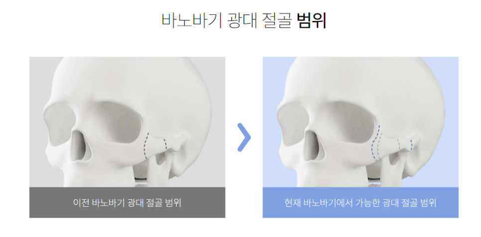 피부처짐까지 예방하는 바노바기 광대 성형! 관련 이미지 2