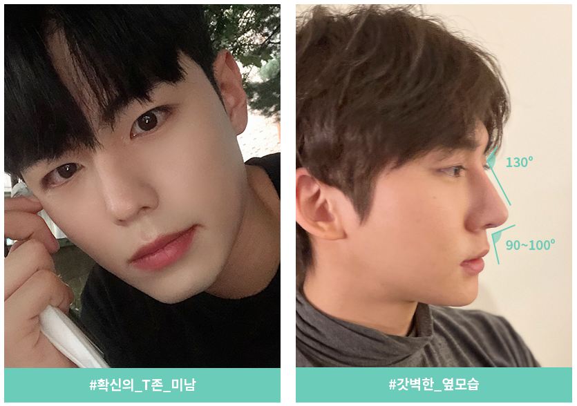 잘생김의 시작, 남자 코성형 관련 이미지 2