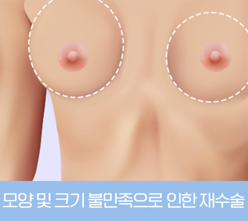 가슴 재수술, 원인에 따라 달라지는 개선 방법 관련 이미지 6