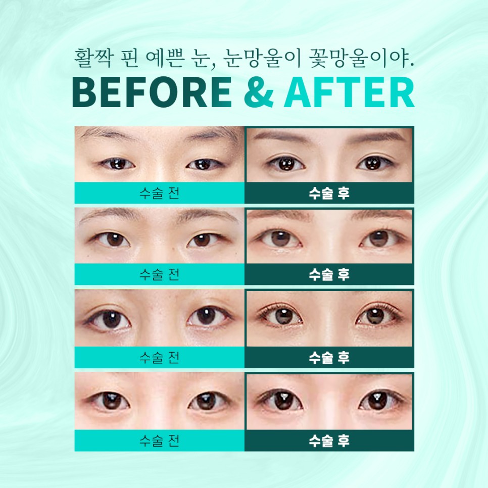 매몰쌍꺼풀 집도의의 기술력에 따라 결과가 다른 이유는? 관련 이미지 2