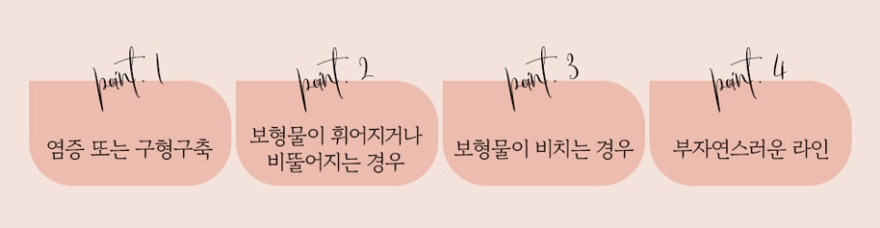 콧대부터 코끝까지 한 번에 끝내는 바노바기 코 성형 관련 이미지 2