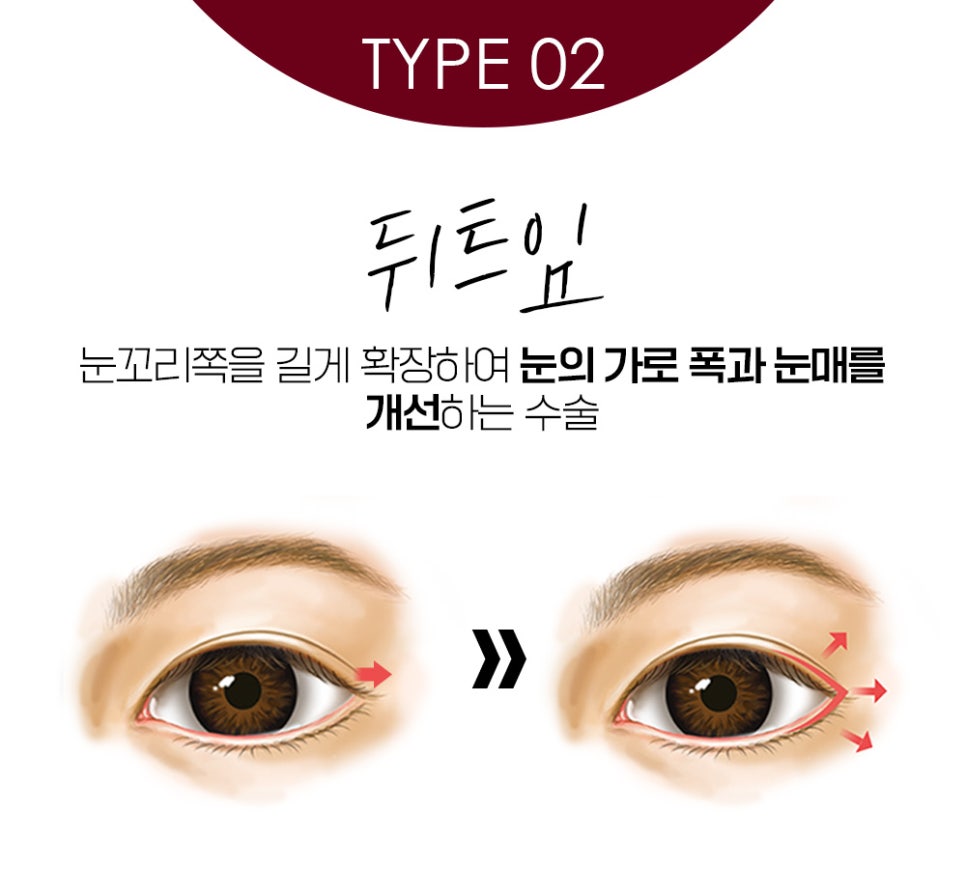 나에게 맞는 트임 성형으로 크고 또렷한 눈매로 개선 관련 이미지 4