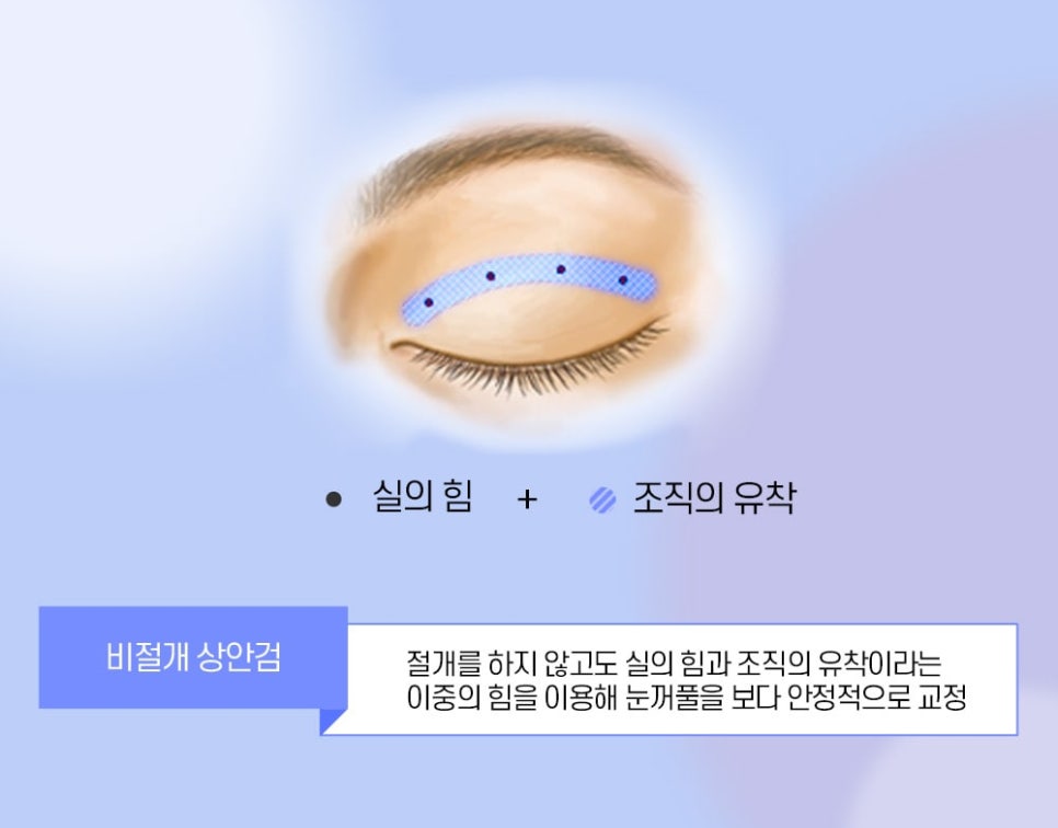 노화로 인한 눈꺼풀 처짐, 비절개 상안검으로 개선할 수 있습니다! 관련 이미지 3