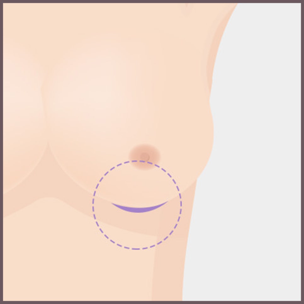 가슴 성형 수술의 핵심! 보형물의 종류와 위치, 절개법 관련 이미지 8