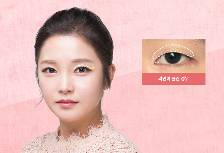 눈재수술, 더 이상 망설이지 마세요! 관련 이미지 3