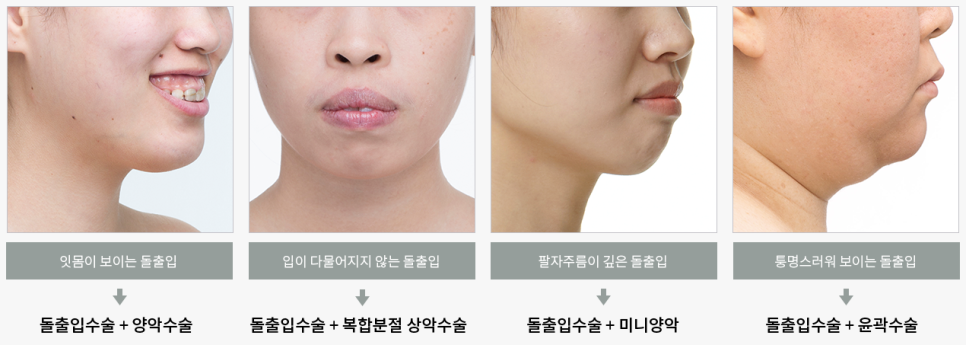 돌출 입, 쏙 집어넣는 방법! 관련 이미지 4