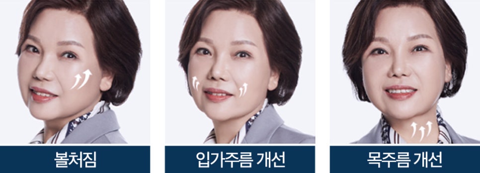 근막층까지 확실하게 당기는 바노바기 하안면부거상 관련 이미지 2