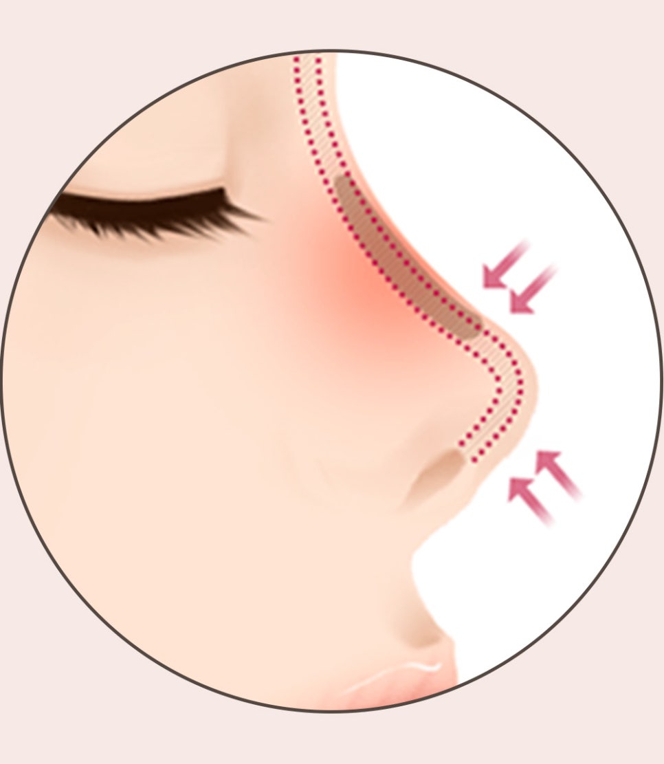 코 재수술의 다양한 원인과 개선 방법! 관련 이미지 6