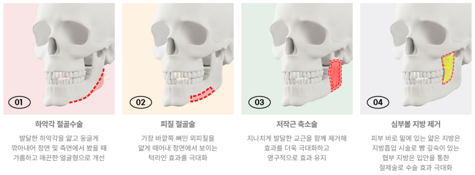 어느 각도에서든 날렵하게, 사각턱 수술 관련 이미지 3