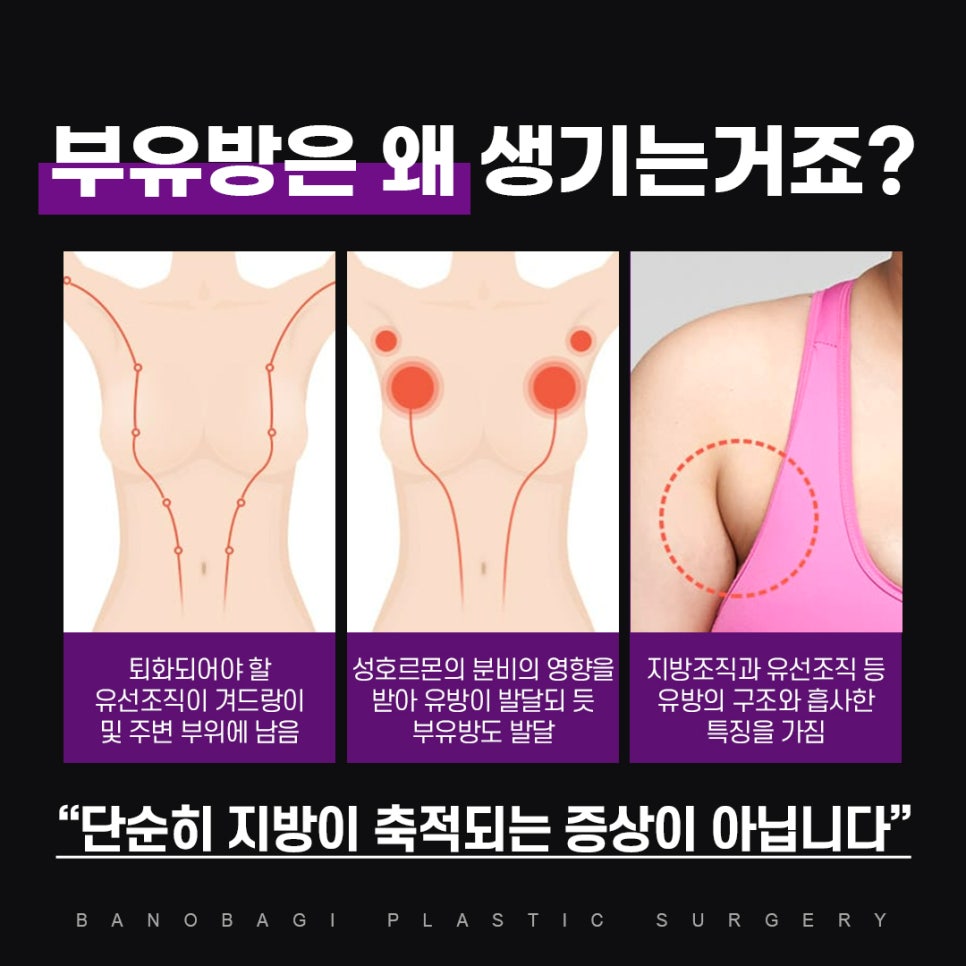 부유방 교정, 가슴과 팔로 이어지는 매끄러운 겨드랑이 라인 관련 이미지 2