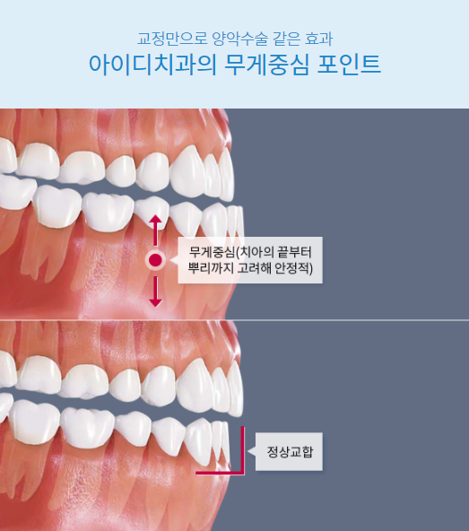 돌출입치아교정, 수술 부담없이 개선가능 관련 이미지 6