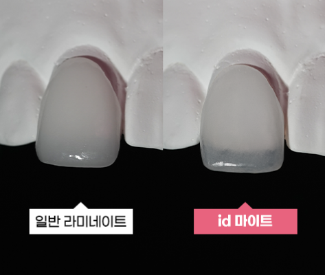 라미네이트 치료를 위한 정보 관련 이미지 2