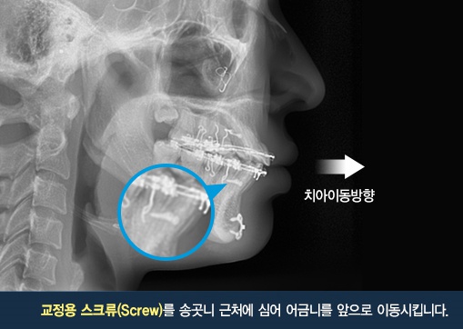 돌출입교정기간 돌출입도 합죽이도 치료가능 관련 이미지 5