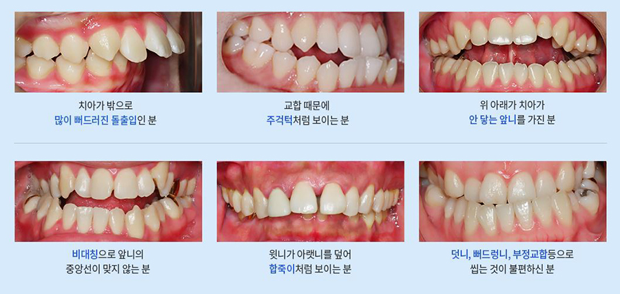 어린이 부정교합 놓치지 않도록 조기부터 시작해야해 관련 이미지 2