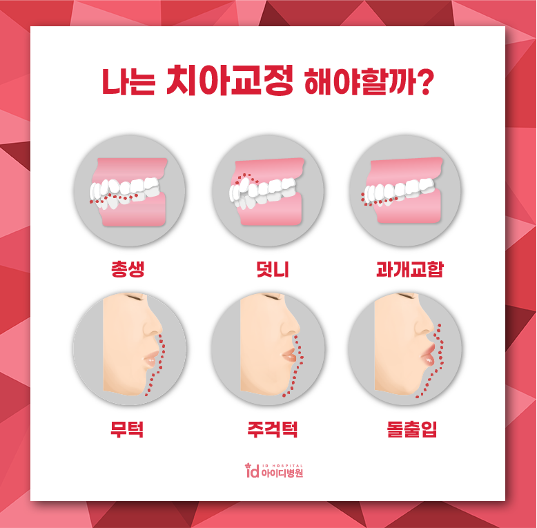 치아교정이 필요한 원인과 경우 관련 이미지 2