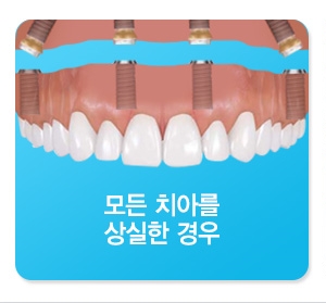 제2의치아 임플란트의 종류 관련 이미지 6
