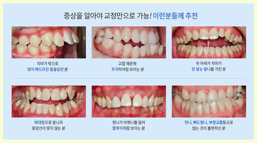 청소년치아교정 사춘기 치아고민 조기에 바로잡자 관련 이미지 4