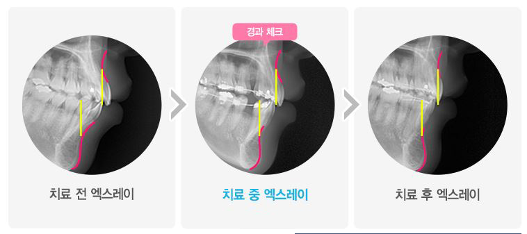 돌출입 치아교정, 수술없이 정상교합으로 관련 이미지 4