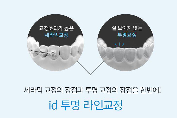 치아투명교정 마무리 확실한곳 있으니 투명교정효과 못봤다면 주목! 관련 이미지 4