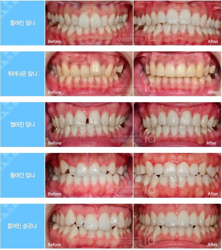 앞니설측교정 발음문제 해결, 심미적인 치아교정 관련 이미지 5