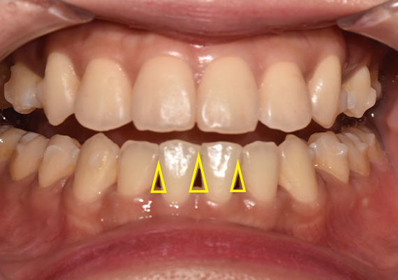Gum Filler: When the Empty Space Between Teeth Becomes a Concern image 4