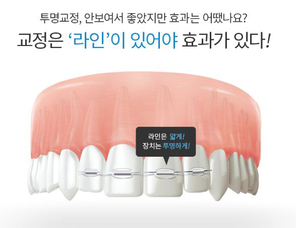투명교정기 효과가 걱정된다면? 아이디 투명라인교정! 관련 이미지 2