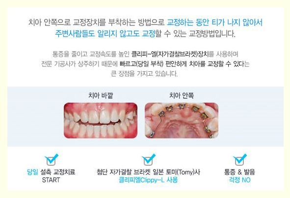 안보이는교정 아직도 감추고 다닐 걱정하세요? 관련 이미지 3
