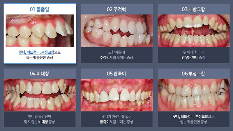 돌출입교정가격 옥니걱정 이제그만 부정교합치아교정 관련 이미지 4