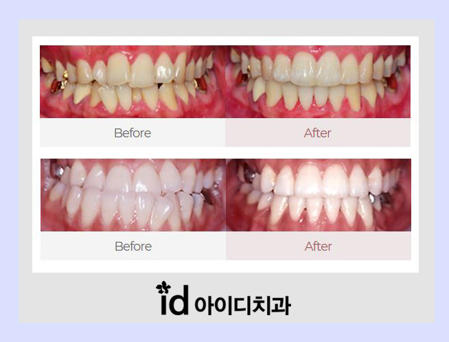 인비절라인 투명교정 비용 부담? 모델모집 기회 놓치지마세요 관련 이미지 3