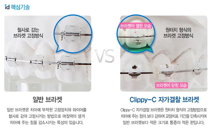 앞니부분교정후기 치아에 슬림하게 밀착되니 편해 관련 이미지 2