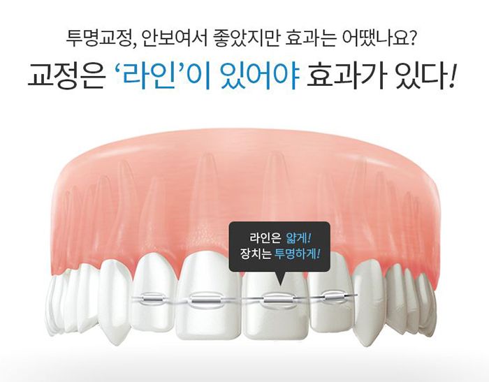 치아투명교정 마무리 확실한곳 있으니 투명교정효과 못봤다면 주목! 관련 이미지 3