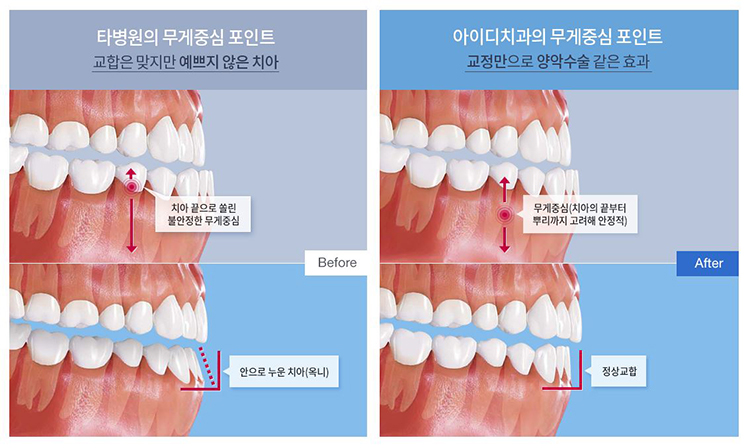 돌출입교정가격 옥니걱정 이제그만 부정교합치아교정 관련 이미지 2