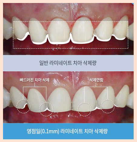 0.1mm 앞니 라미네이트 비용 자연치아 살리면서 튼튼하게 관련 이미지 2