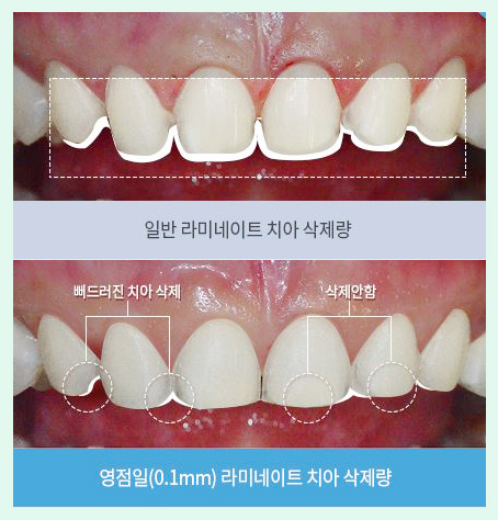 0.1라미네이트 무조건 깎지말고 지키세요~ 영점일 라미네이트 관련 이미지 2