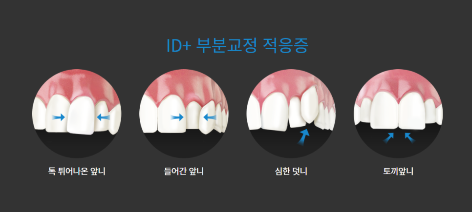 앞니 부분교정, 간단하게 꼭 필요한 부위만 관련 이미지 3