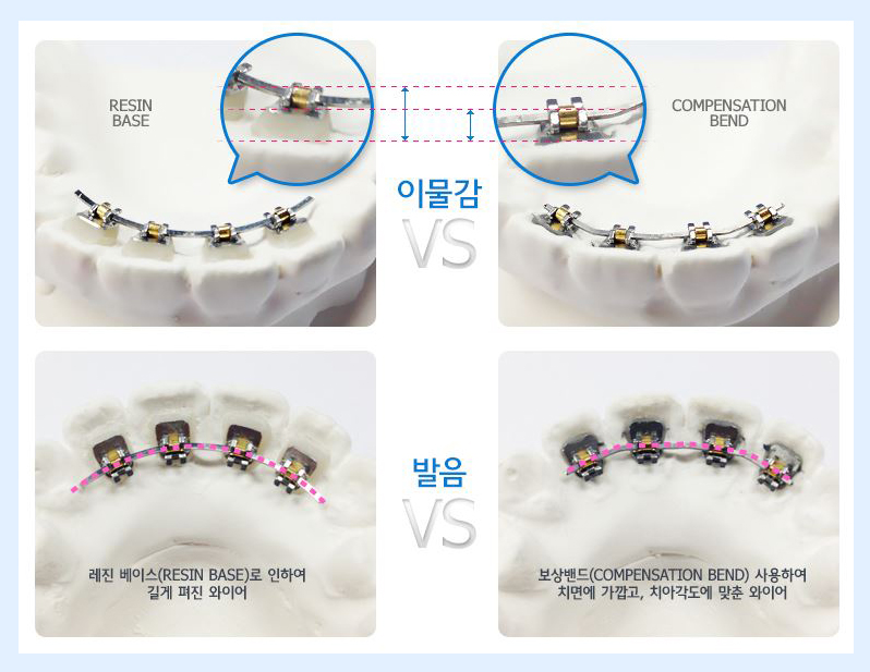 설측교정후기 보일 걱정없이 비밀스럽게 관련 이미지 3