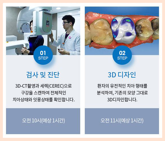 0.1mm 앞니 라미네이트 비용 자연치아 살리면서 튼튼하게 관련 이미지 4