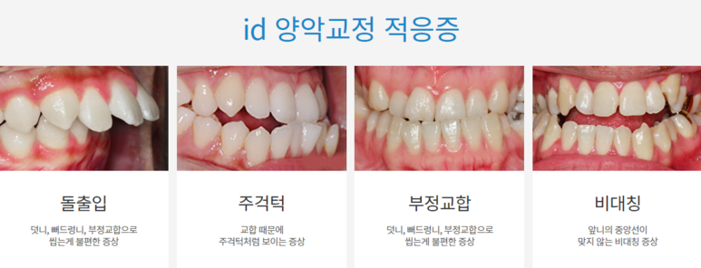 돌출입치아교정, 무조건 수술만 고려할 필요 없어 관련 이미지 4