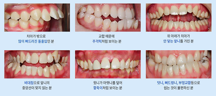 어린이교정 예민한만큼 섬세한 손길이 필요할때! 관련 이미지 5