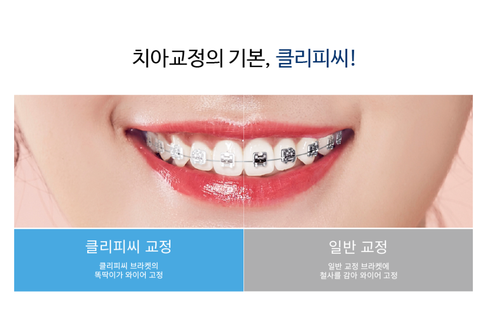 치아교정, 종류와 선택의 기준은? 관련 이미지 5