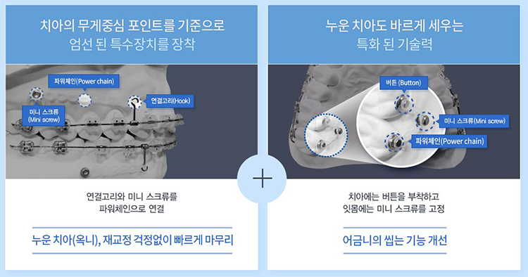 돌출입교정가격 옥니걱정 이제그만 부정교합치아교정 관련 이미지 3