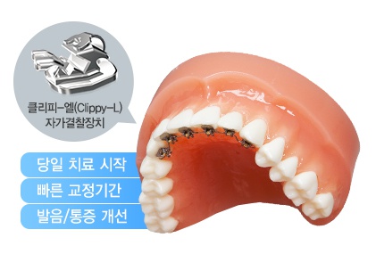 앞니설측교정 발음문제 해결, 심미적인 치아교정 관련 이미지 2